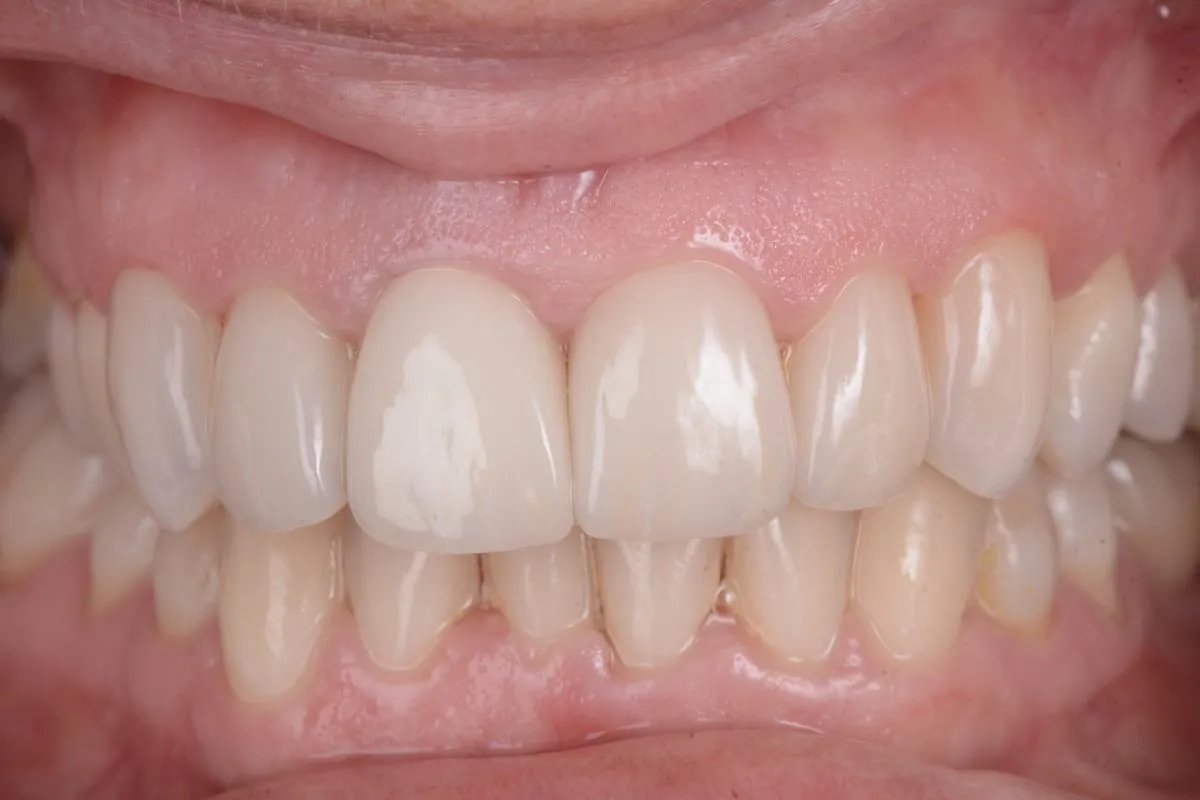 Sonrisa después del tratamiento estético