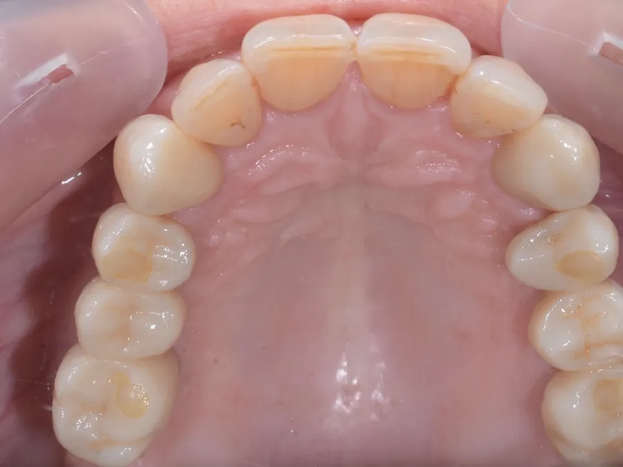 Vista oclusal de una boca rehabilitada con coronas y restauraciones
